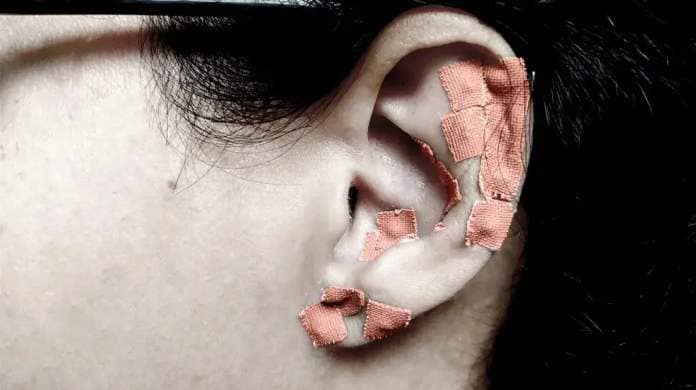 A person's ear taped at multiple acupuncture pressure points with surgical tape