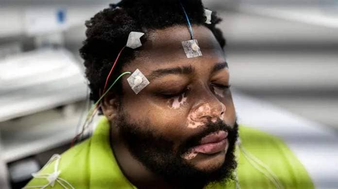 A close-up of a male patient's head and face, with electrodes attached to the forehead