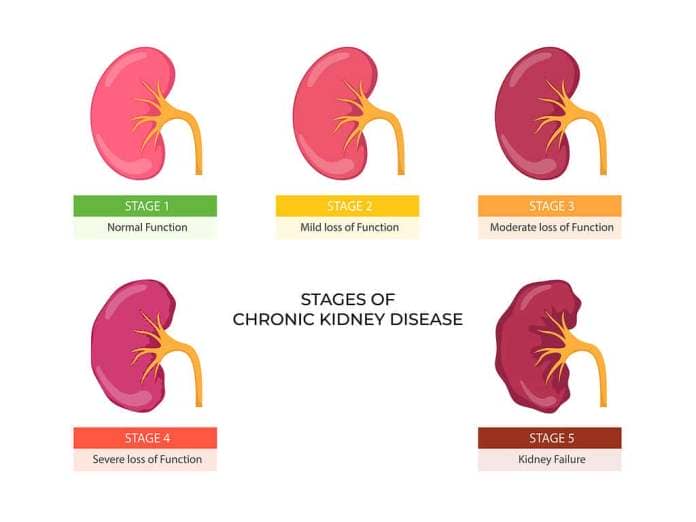 Stages of chronic kidney disease. Problem in urinary system and normal kidney