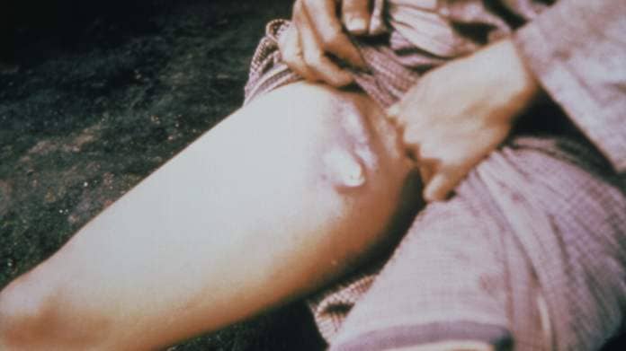 photo of a person pulling up their pant leg to show buboes (swollen lymph nodes caused by plague) on their inner thigh